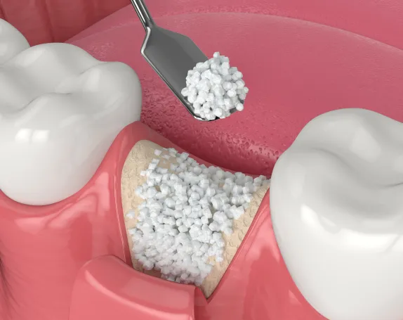 Bone Grafting at Smile Breeze Dentistry