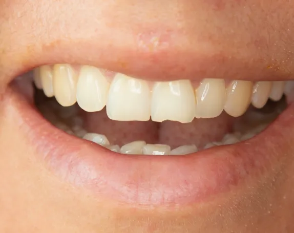 Cracked Teeth Treatment at Smile Breeze Dentistry