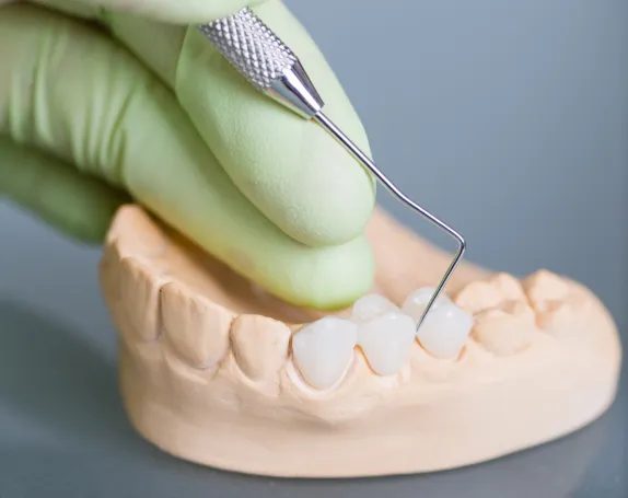 Dental Bridges at Smile Breeze Dentistry
