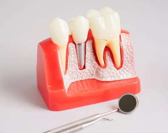 Dental Implantsg at Smile Breeze Dentistry