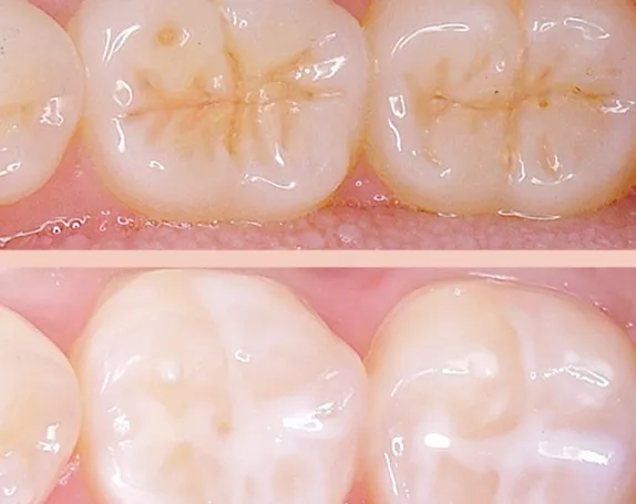 Dental Sealants at Smile Breeze Dentistry