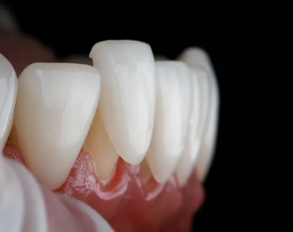 Dental Veneers at Smile Breeze Dentistry