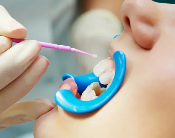 Fluoride Treatment at Smile Breeze Dentistry