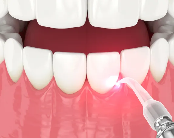 Gum Disease Treatment at Smile Breeze Dentistry