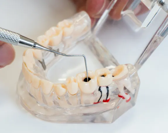 Root Canal Retreatment at Smile Breeze Dentistry