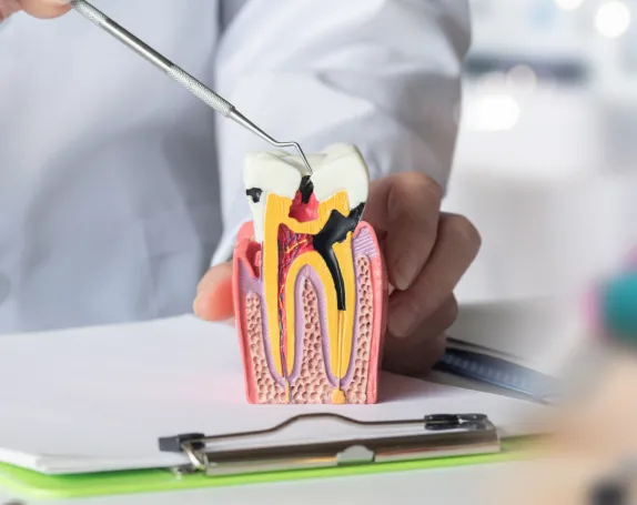 Root Canal Therapy at Smile Breeze Dentistry