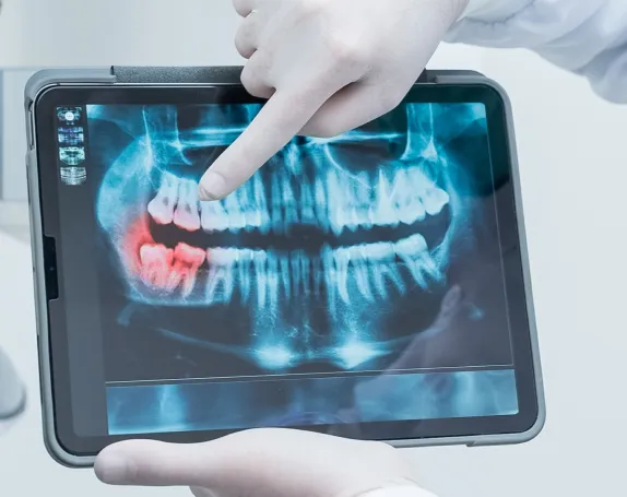 Wisdom Teeth Removal at Smile Breeze Dentistry